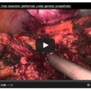 Thumbnail for New Case Discussion on myHPB