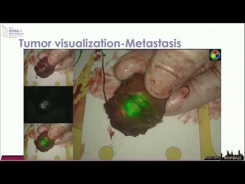 US15 Use of ICG in Liver Surgery