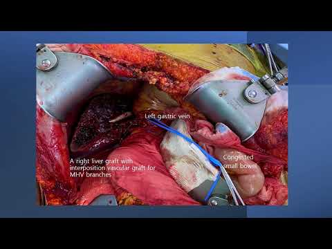 US17: Management of Small for Size Syndrome in 2022