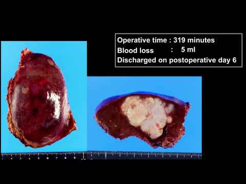 VID03: Liver 1