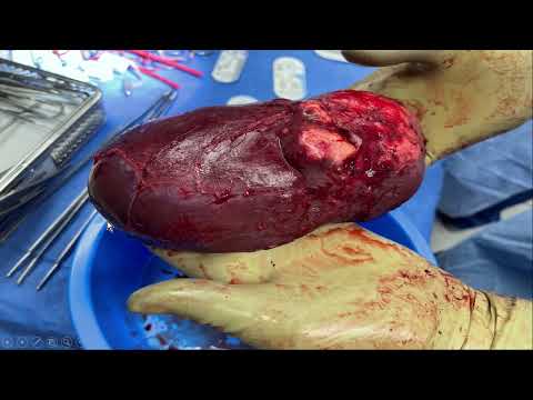 IS02: Strategic Use of Preoperative Imaging