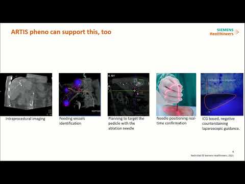 IS05: Round Table for Hybrid Operating Rooms’ Potential in HBP Therapies, and Quality in Ablation