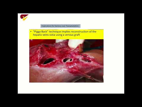 SYM14: IHPBA Meets ILTS: Technical Challenges in Deceased Donor Liver Transplantation 