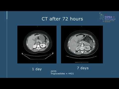 SYM21: Acute Pancreatitis