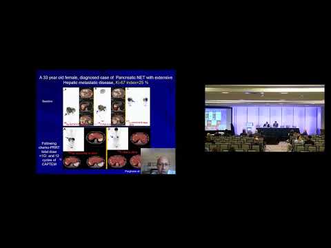 SYM28: Metastatic Neuroendocrine Tumours