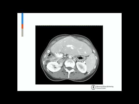 DEB10: Advanced CRLM: HAI Pump vs Transplant