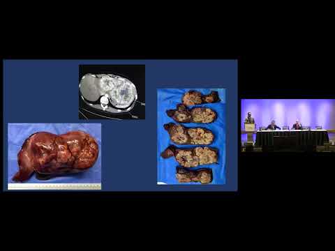 DEB14: Aggressive Liver Surgery for Locally Advanced Cancer: Is there a role or not?