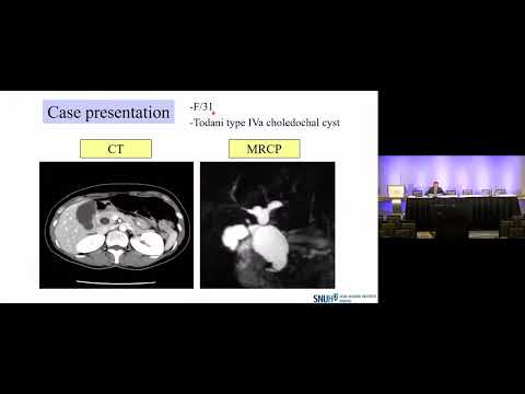 KN05: Management of Choledochal Cysts