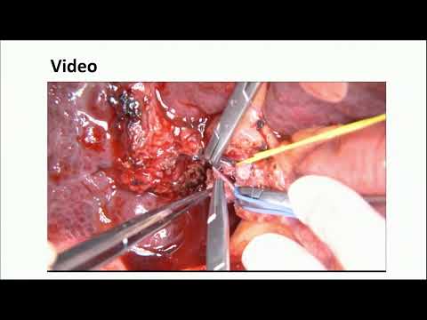 KN08: Liver Resection in Advanced HCC