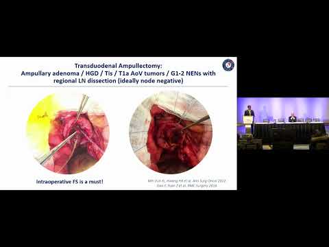 US02: Ampullary Adenocarcinoma: Prognostic Factors and Surgery