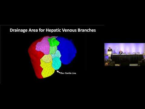 US09: What is Needed for Near-ZERO Mortality in Liver Surgery?