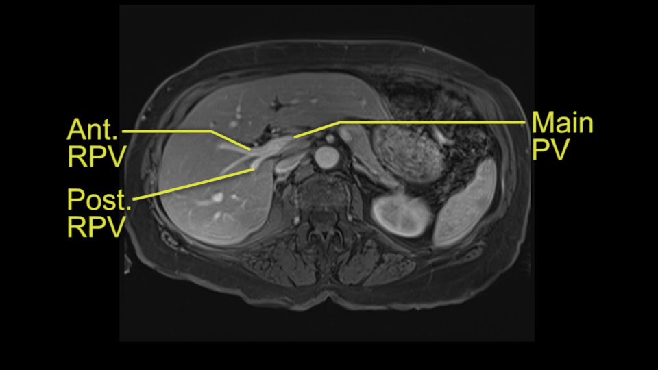 [Ant. RPV] [Main PV] [Post. RPV]