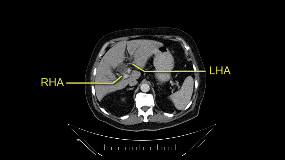 preOp_SS_momentPro5a